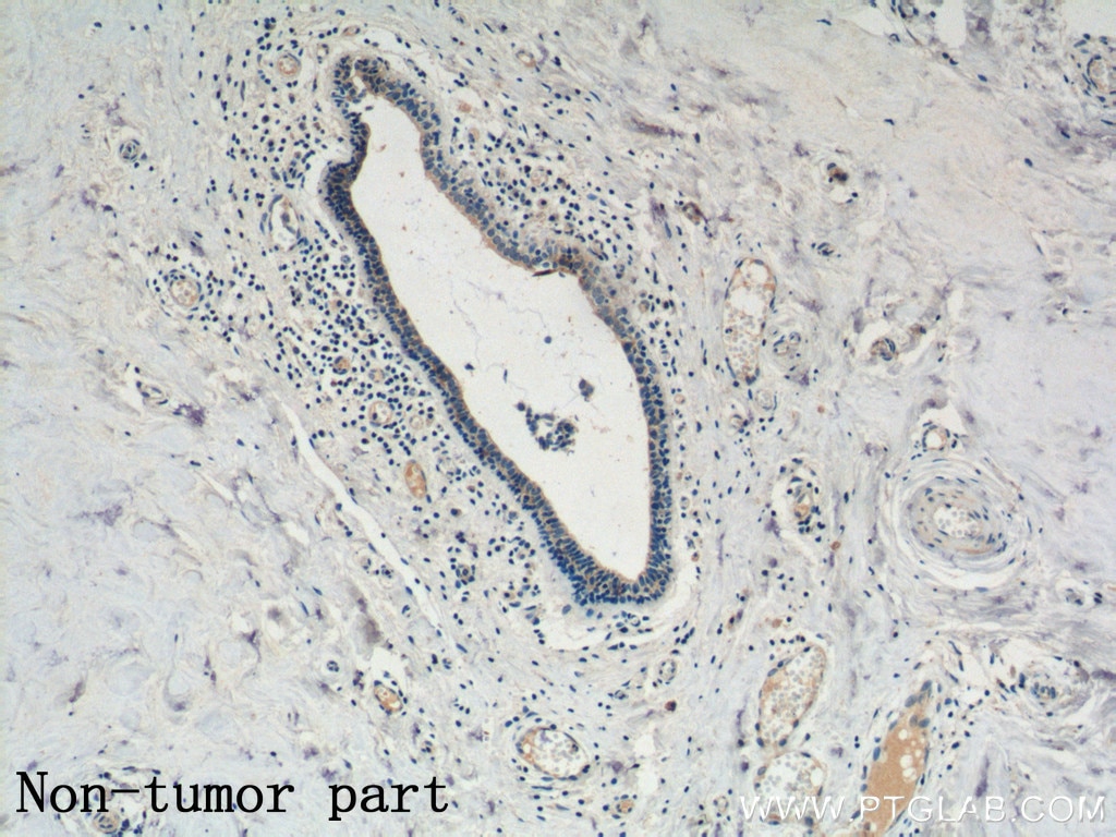 Immunohistochemistry (IHC) staining of human breast cancer tissue using KLRG1 Polyclonal antibody (10974-1-AP)