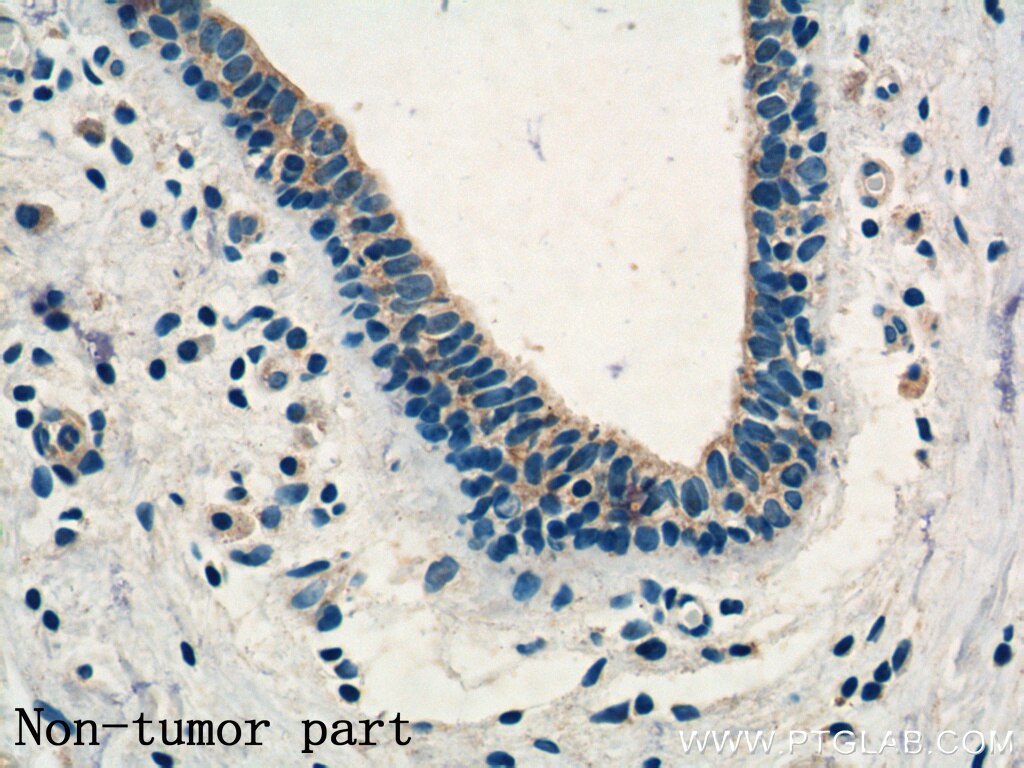 Immunohistochemistry (IHC) staining of human breast cancer tissue using KLRG1 Polyclonal antibody (10974-1-AP)