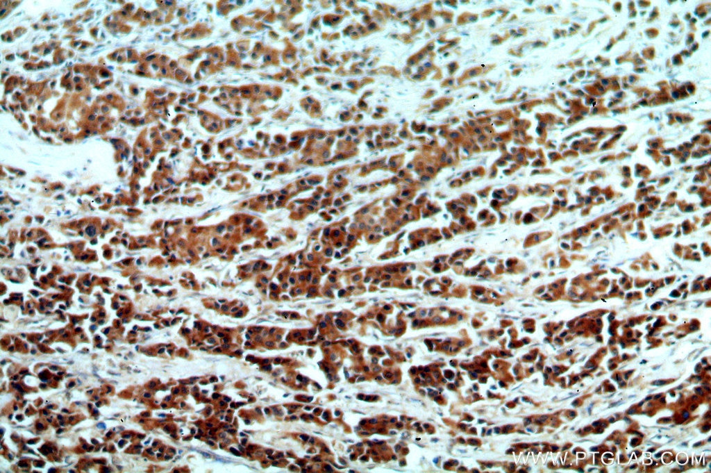 Immunohistochemistry (IHC) staining of human breast cancer tissue using KMO Polyclonal antibody (10698-1-AP)