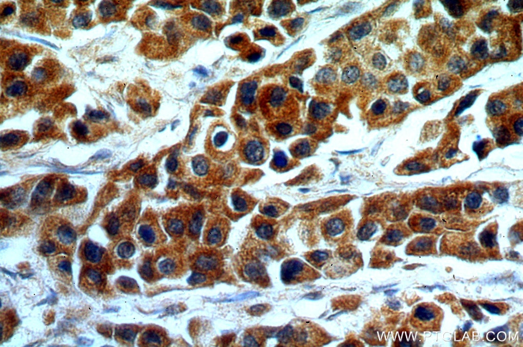 Immunohistochemistry (IHC) staining of human breast cancer tissue using KMO Polyclonal antibody (10698-1-AP)