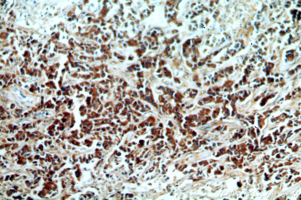 Immunohistochemistry (IHC) staining of human breast cancer tissue using KMO Polyclonal antibody (10698-1-AP)