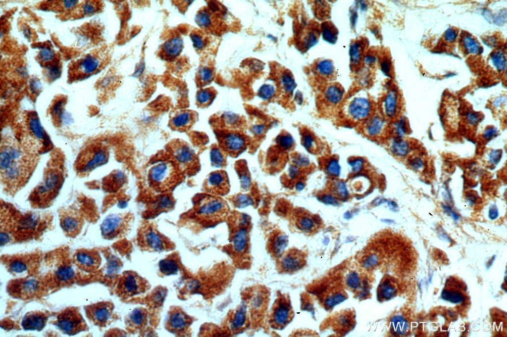 Immunohistochemistry (IHC) staining of human breast cancer tissue using KMO Polyclonal antibody (10698-1-AP)