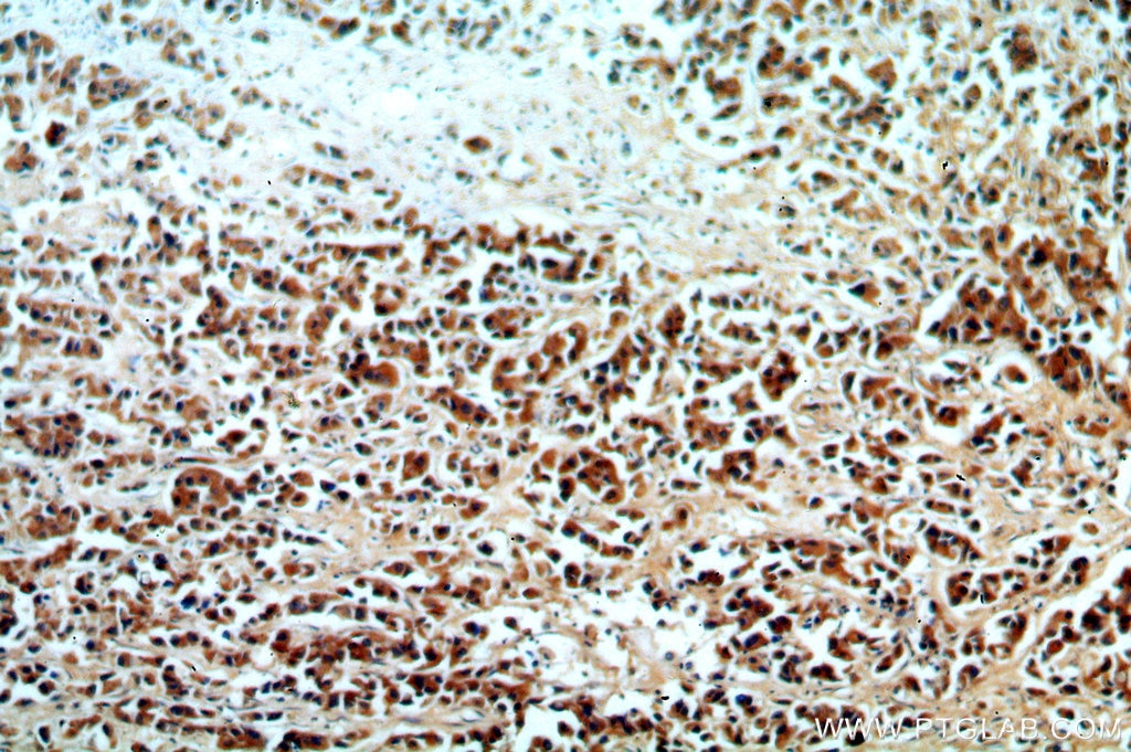 Immunohistochemistry (IHC) staining of human breast cancer tissue using KMO Polyclonal antibody (10698-1-AP)