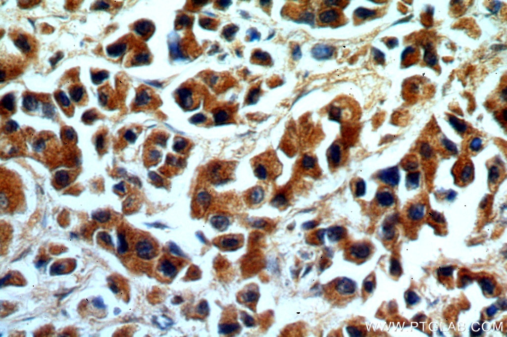 Immunohistochemistry (IHC) staining of human breast cancer tissue using KMO Polyclonal antibody (10698-1-AP)