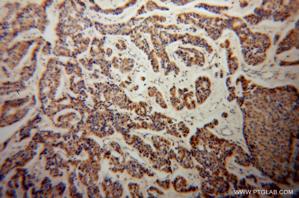 Immunohistochemistry (IHC) staining of human breast cancer tissue using KMO Polyclonal antibody (10698-1-AP)