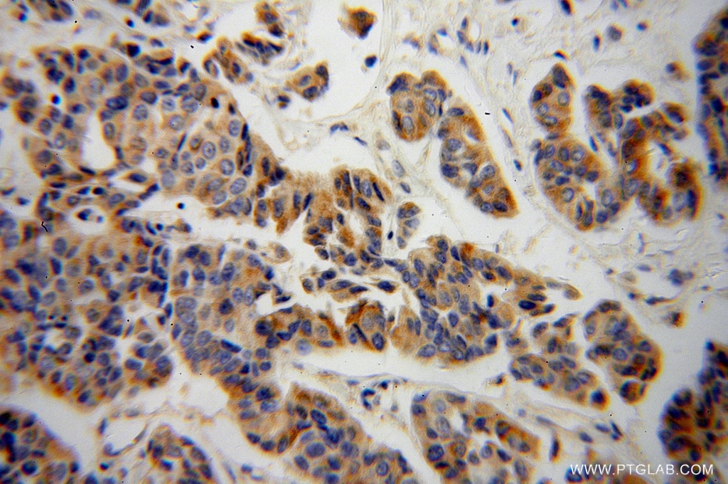 Immunohistochemistry (IHC) staining of human breast cancer tissue using KMO Polyclonal antibody (10698-1-AP)