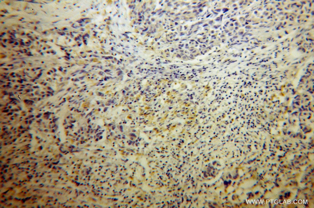 Immunohistochemistry (IHC) staining of human prostate cancer tissue using KMO Polyclonal antibody (10698-1-AP)