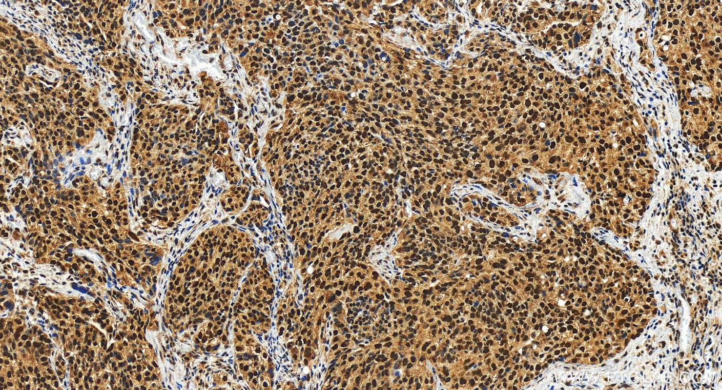 Immunohistochemistry (IHC) staining of human ovary cancer tissue using KMT2C Polyclonal antibody (28437-1-AP)