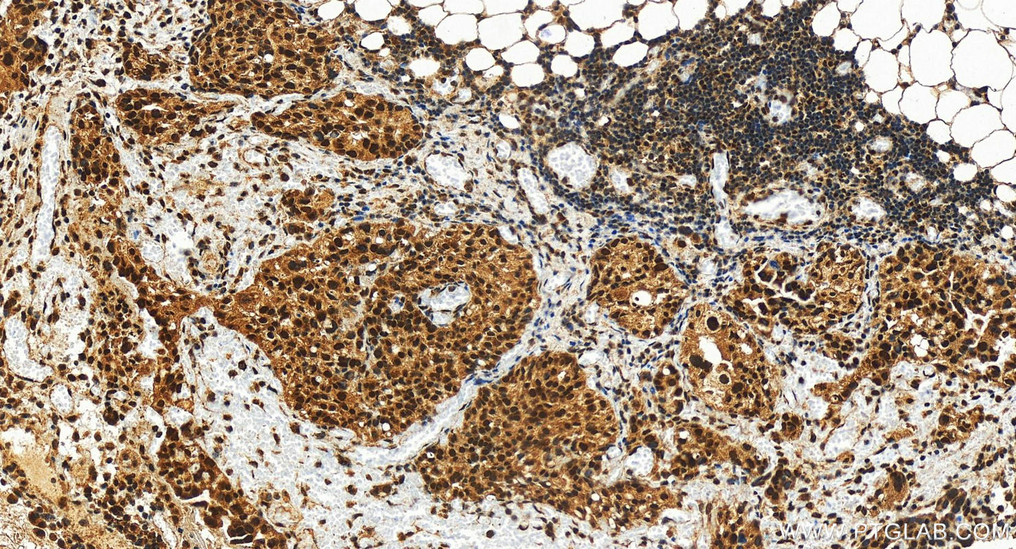 Immunohistochemistry (IHC) staining of human ovary cancer tissue using KMT2C Polyclonal antibody (28437-1-AP)
