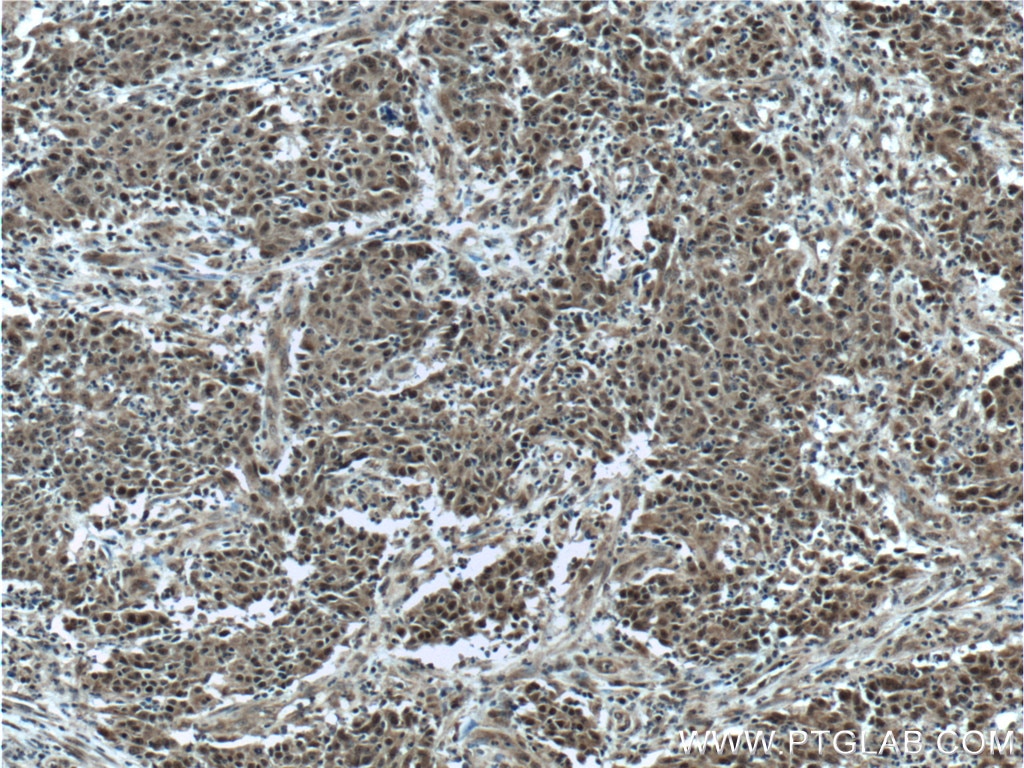 Immunohistochemistry (IHC) staining of human colon cancer tissue using KMT2D Polyclonal antibody (27266-1-AP)