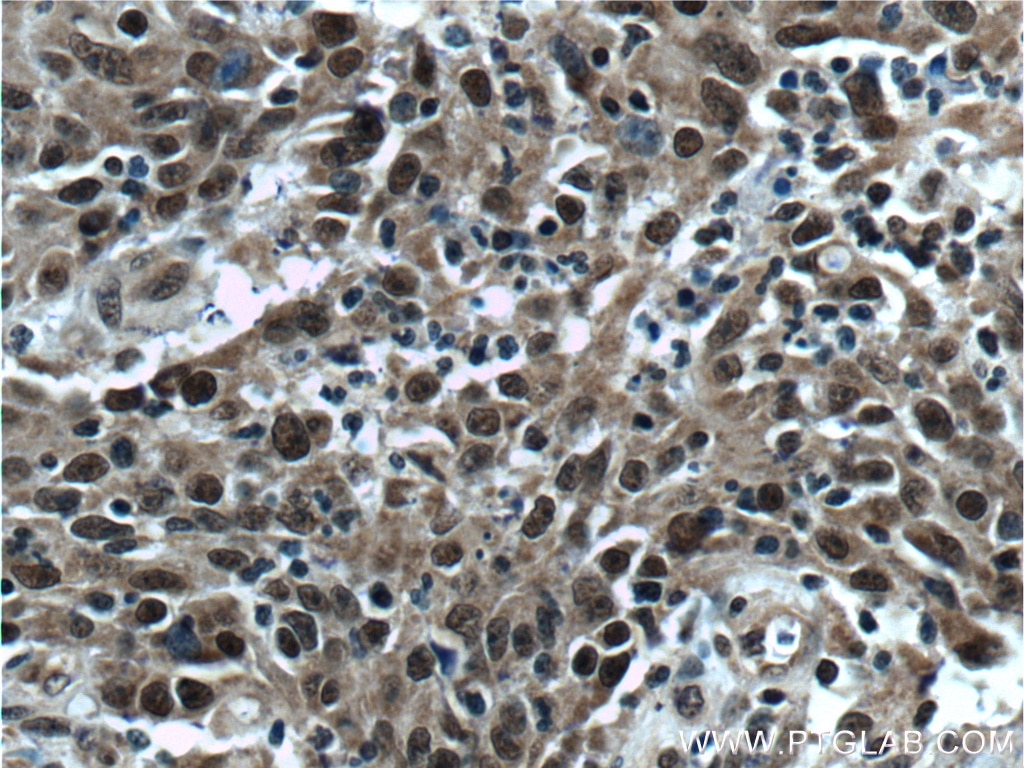 Immunohistochemistry (IHC) staining of human colon cancer tissue using KMT2D Polyclonal antibody (27266-1-AP)