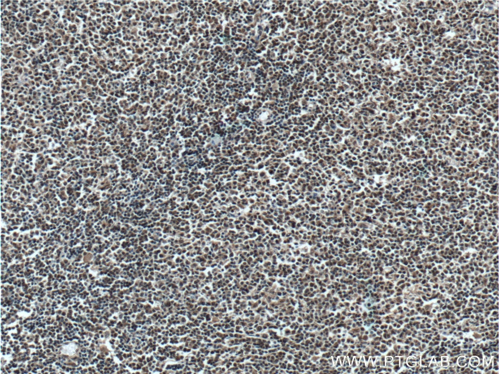 Immunohistochemistry (IHC) staining of human lymphoma tissue using KMT2D Polyclonal antibody (27266-1-AP)