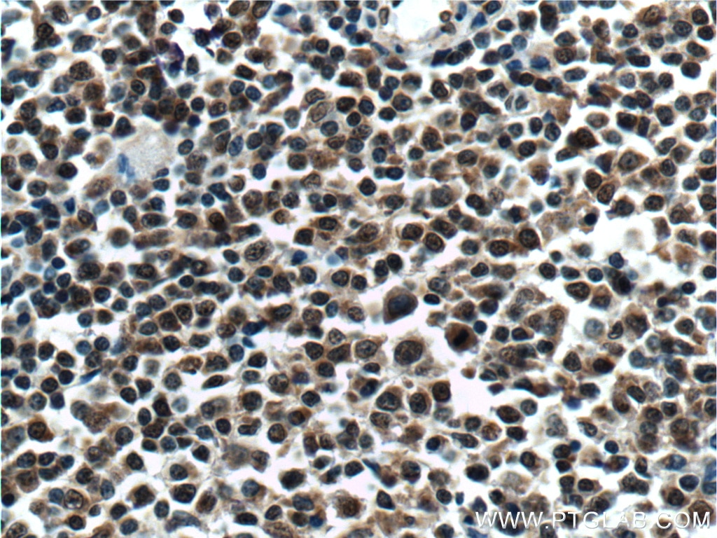 Immunohistochemistry (IHC) staining of human lymphoma tissue using KMT2D Polyclonal antibody (27266-1-AP)