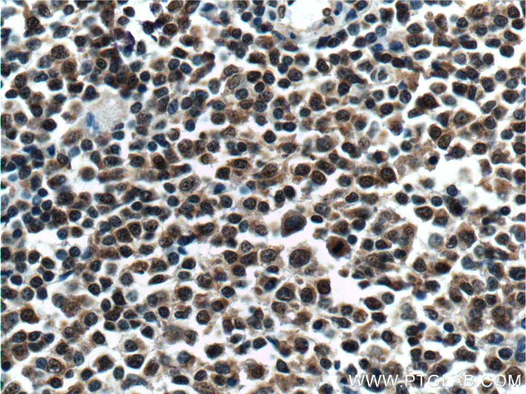 IHC staining of human lymphoma using 27266-1-AP