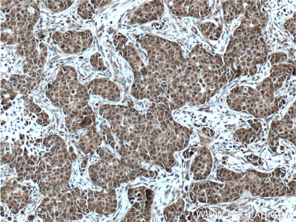 Immunohistochemistry (IHC) staining of human breast cancer tissue using KMT2D Polyclonal antibody (27266-1-AP)