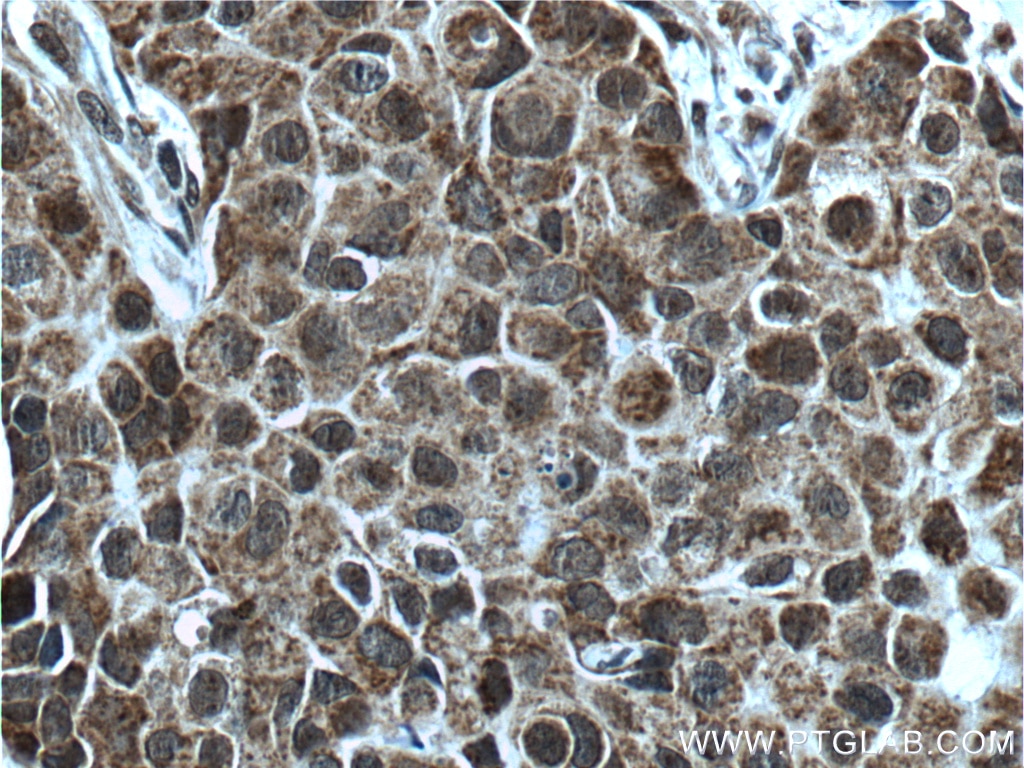Immunohistochemistry (IHC) staining of human breast cancer tissue using KMT2D Polyclonal antibody (27266-1-AP)