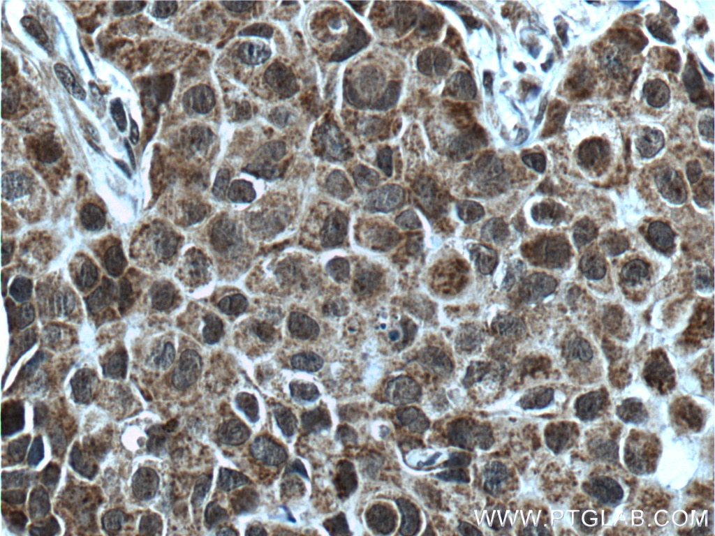 IHC staining of human breast cancer using 27266-1-AP