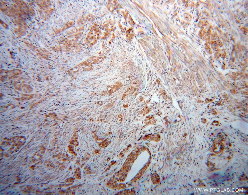 Immunohistochemistry (IHC) staining of human endometrial cancer tissue using Kininogen 1 Polyclonal antibody (11926-1-AP)