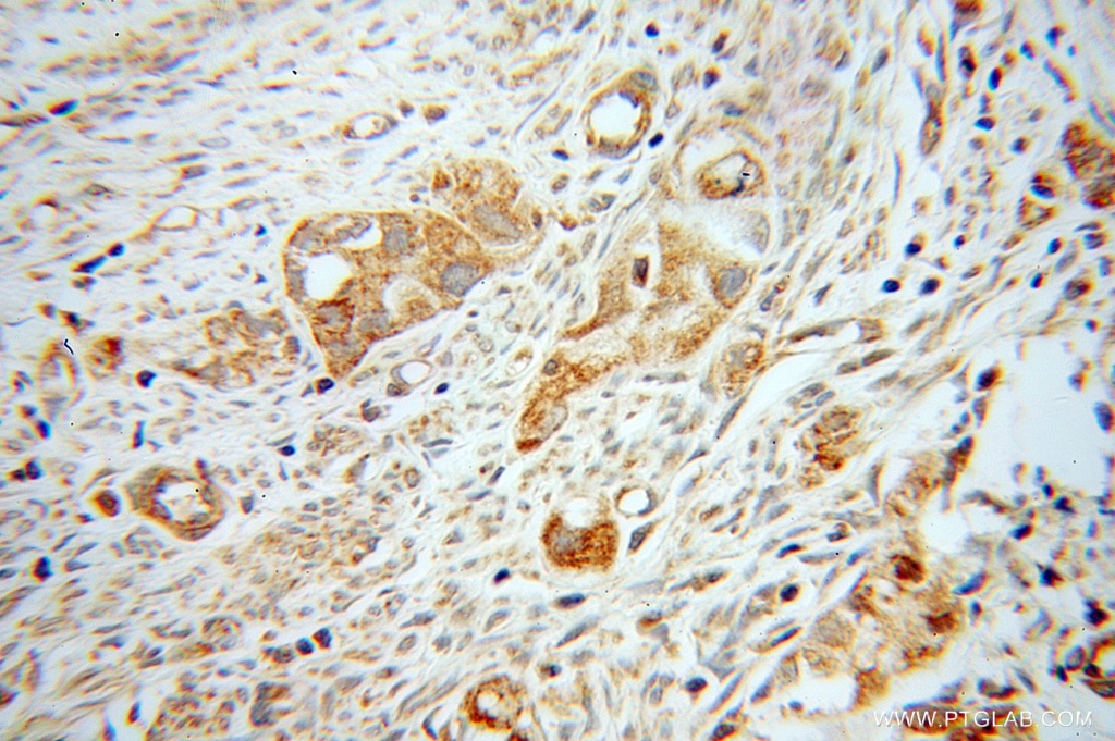 Immunohistochemistry (IHC) staining of human endometrial cancer tissue using Kininogen 1 Polyclonal antibody (11926-1-AP)