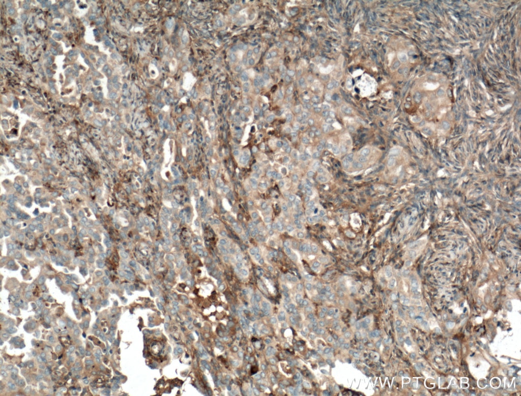Immunohistochemistry (IHC) staining of human ovary tumor tissue using Kininogen 1 Monoclonal antibody (66123-1-Ig)