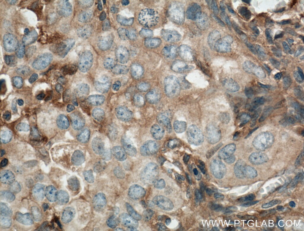 IHC staining of human ovary tumor using 66123-1-Ig