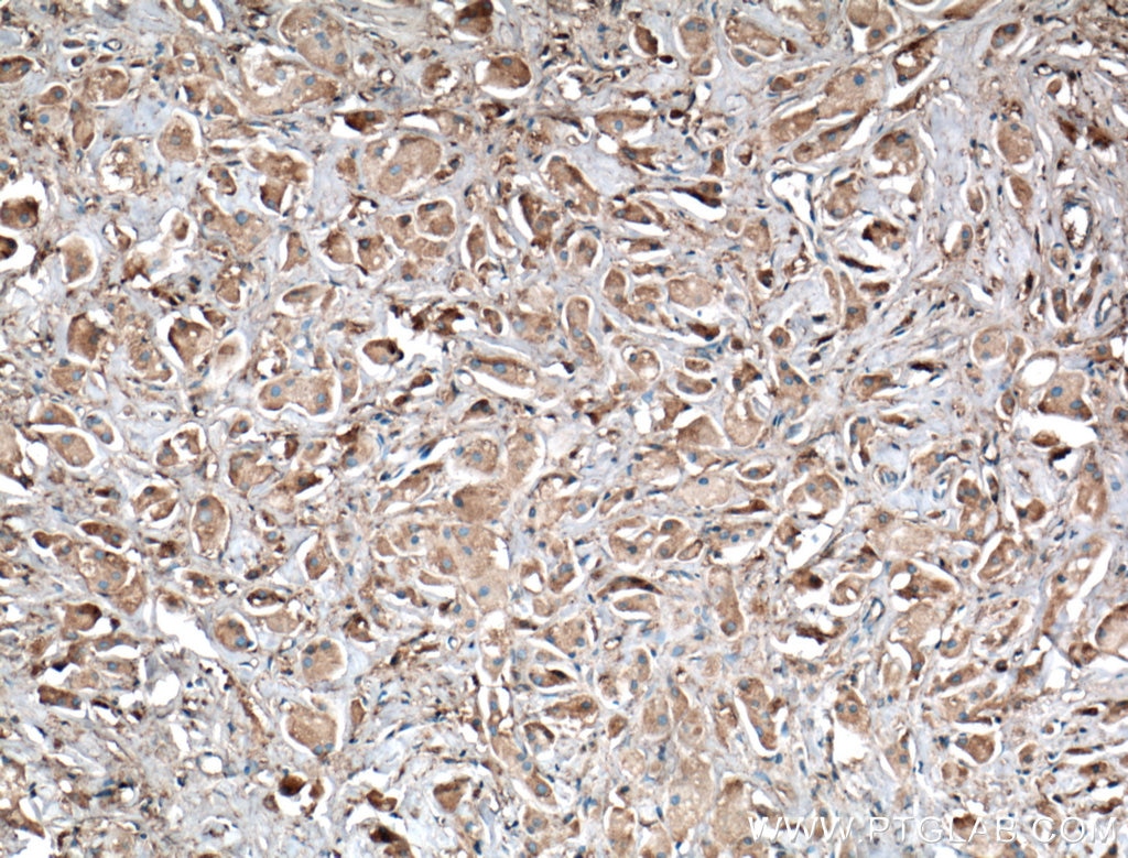 IHC staining of human breast cancer using 66123-1-Ig