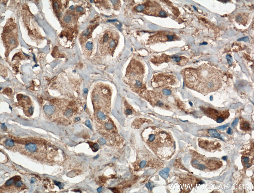 Immunohistochemistry (IHC) staining of human breast cancer tissue using Kininogen 1 Monoclonal antibody (66123-1-Ig)