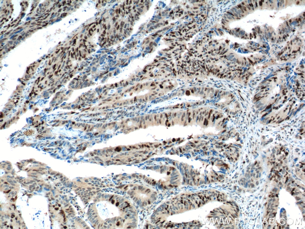 Immunohistochemistry (IHC) staining of human colon cancer tissue using KPNA2 Polyclonal antibody (10819-1-AP)