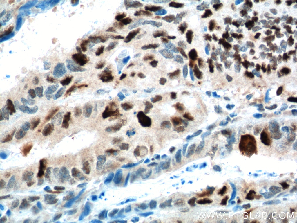 Immunohistochemistry (IHC) staining of human colon cancer tissue using KPNA2 Polyclonal antibody (10819-1-AP)