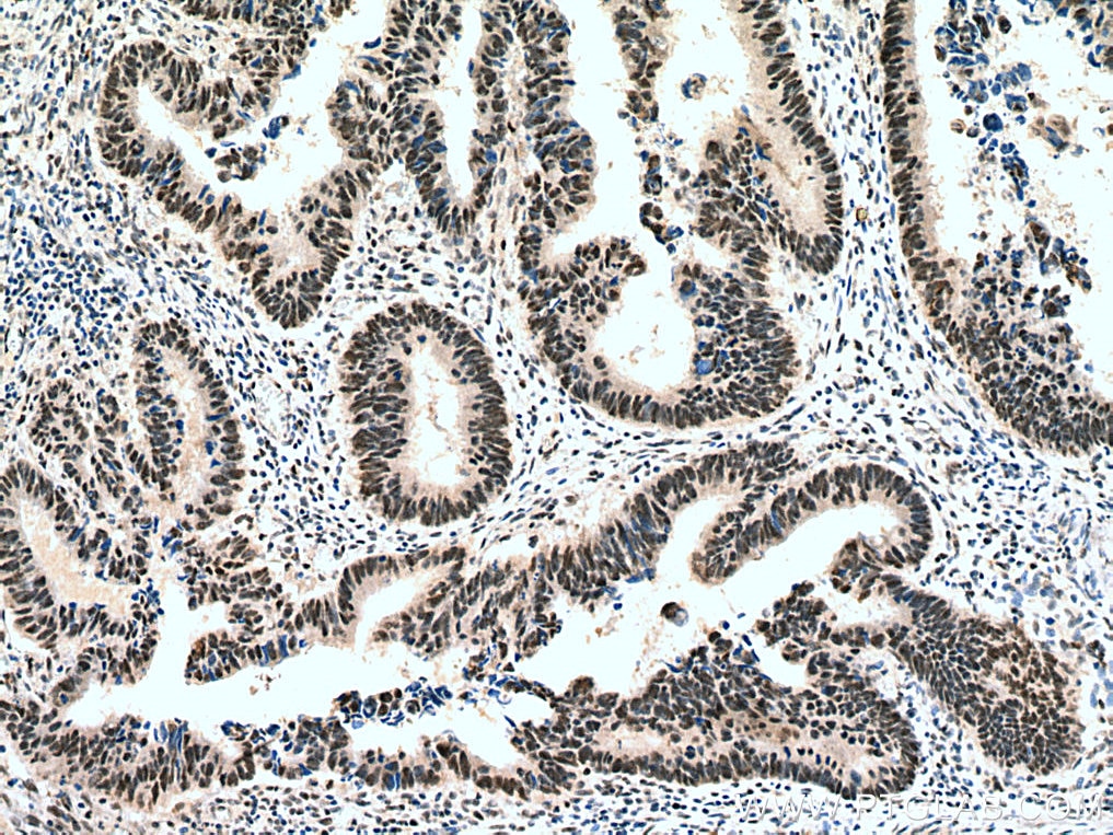 Immunohistochemistry (IHC) staining of human colon cancer tissue using KPNA4 Polyclonal antibody (12463-1-AP)