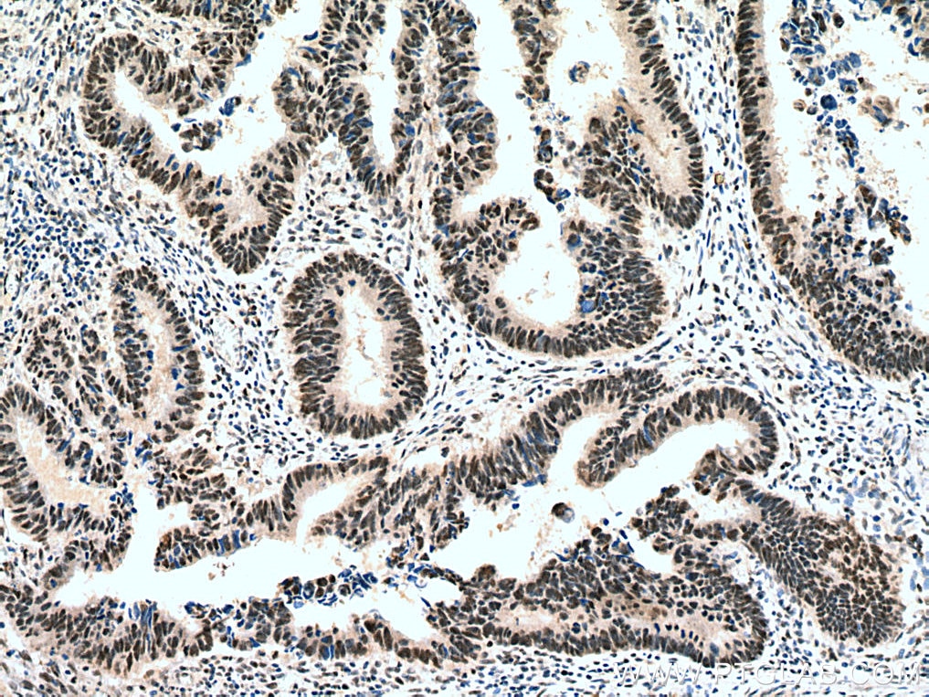 IHC staining of human colon cancer using 12463-1-AP