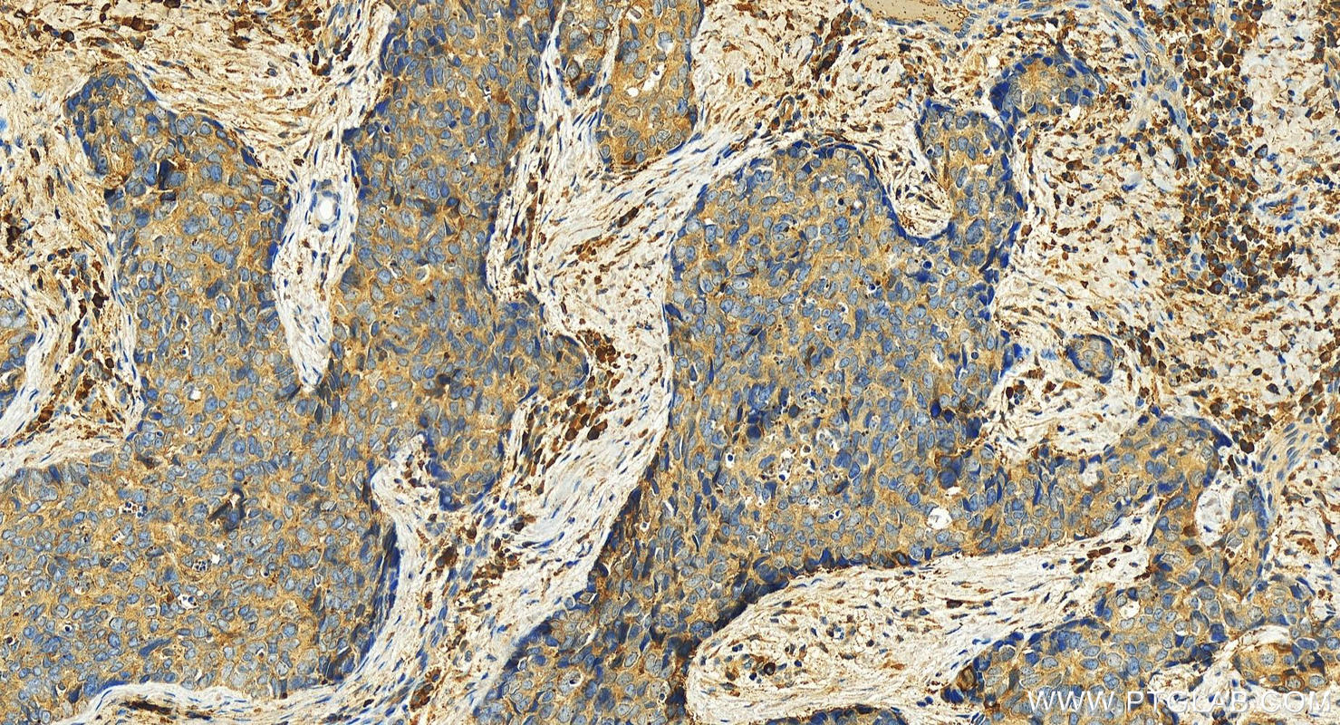 Immunohistochemistry (IHC) staining of human bowen disease tissue using KPNA4 Polyclonal antibody (12463-1-AP)