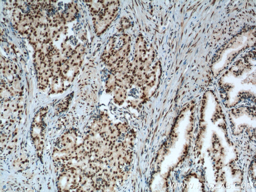 Immunohistochemistry (IHC) staining of human prostate cancer tissue using KPNA6 Polyclonal antibody (12366-2-AP)
