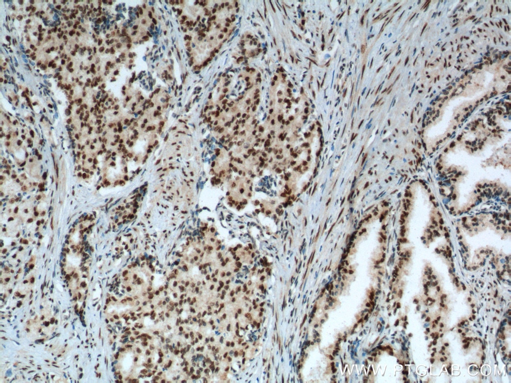 IHC staining of human prostate cancer using 12366-2-AP