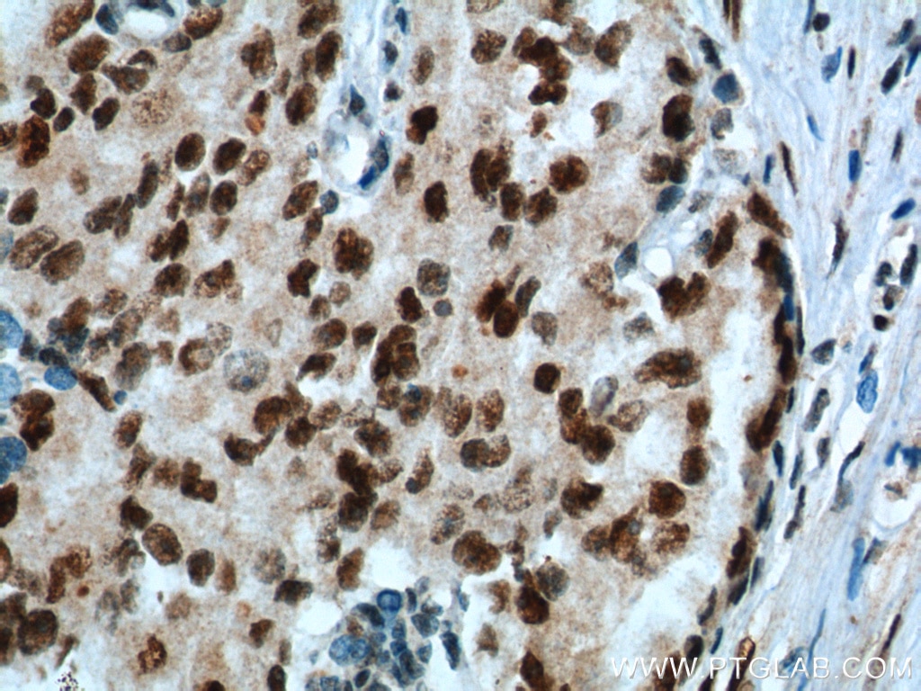 Immunohistochemistry (IHC) staining of human prostate cancer tissue using KPNA6 Polyclonal antibody (12366-2-AP)