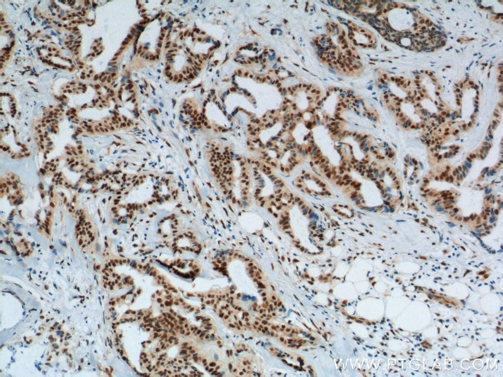 Immunohistochemistry (IHC) staining of human breast cancer tissue using KPNA6 Polyclonal antibody (12366-2-AP)