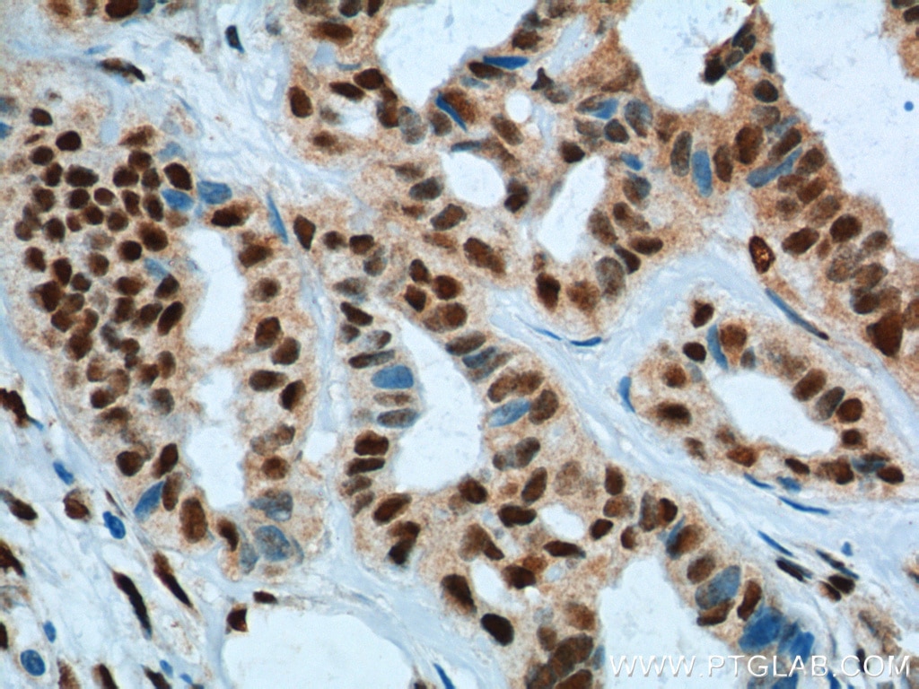 Immunohistochemistry (IHC) staining of human breast cancer tissue using KPNA6 Polyclonal antibody (12366-2-AP)