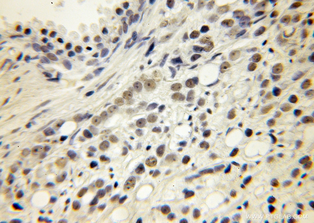 Immunohistochemistry (IHC) staining of human prostate cancer tissue using KPNA6 Polyclonal antibody (12366-2-AP)