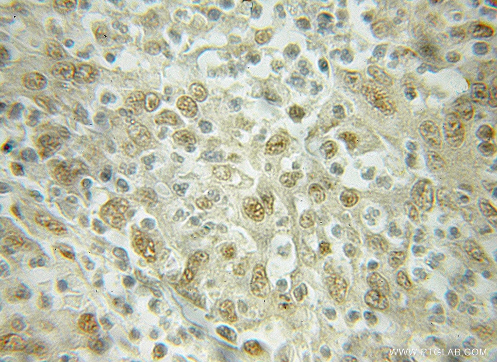 Immunohistochemistry (IHC) staining of human colon cancer tissue using Importin Beta Polyclonal antibody (10077-1-AP)