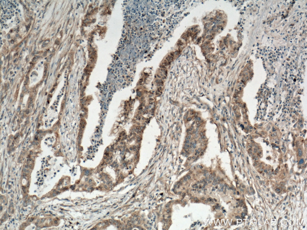 Immunohistochemistry (IHC) staining of human pancreas cancer tissue using KRAS Polyclonal antibody (12063-1-AP)