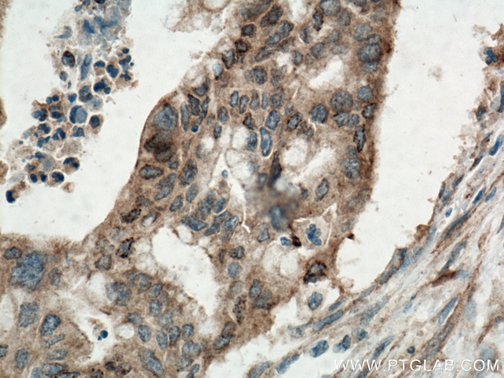 Immunohistochemistry (IHC) staining of human pancreas cancer tissue using KRAS Polyclonal antibody (12063-1-AP)