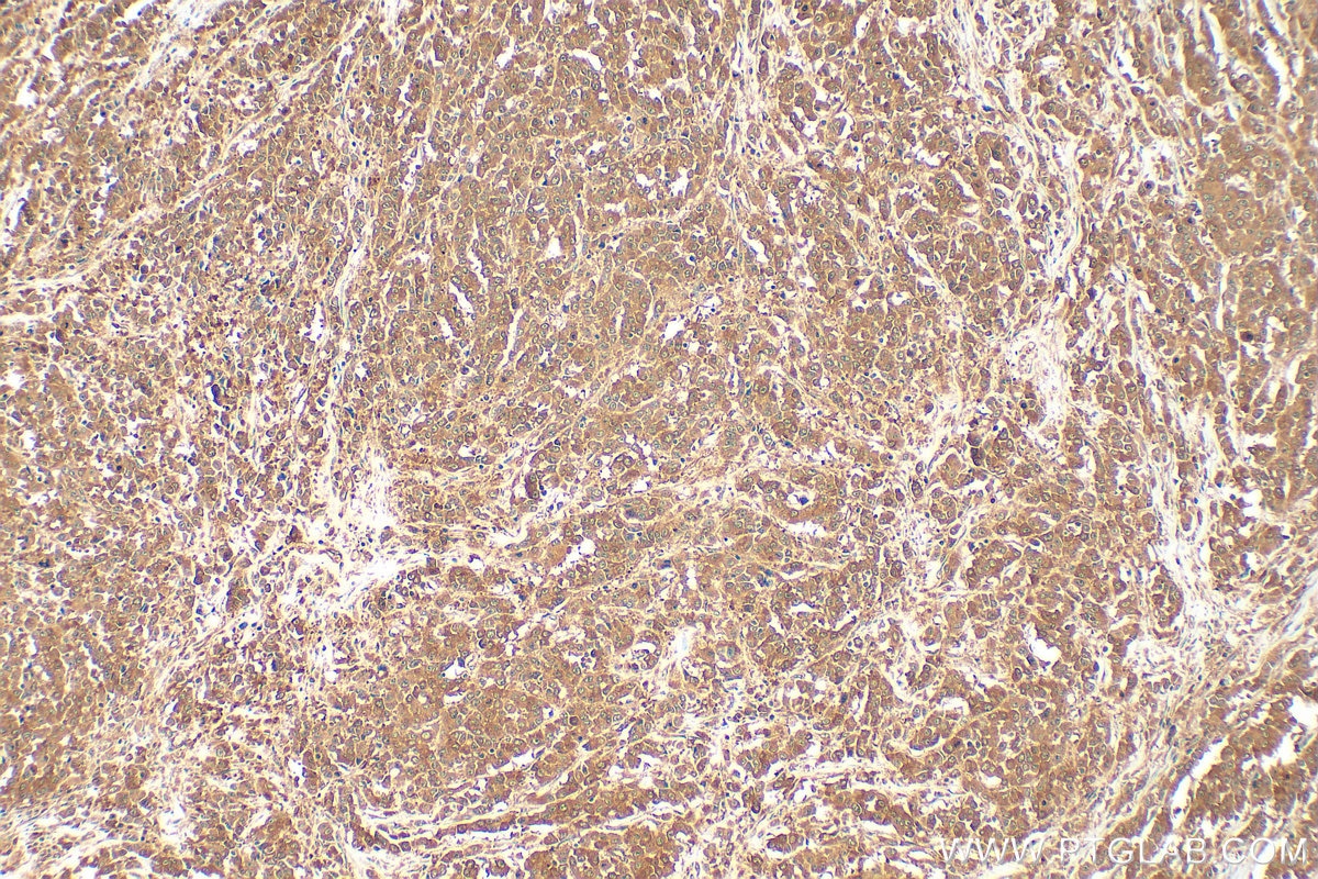 Immunohistochemistry (IHC) staining of human colon cancer tissue using KRAS Polyclonal antibody (12063-1-AP)