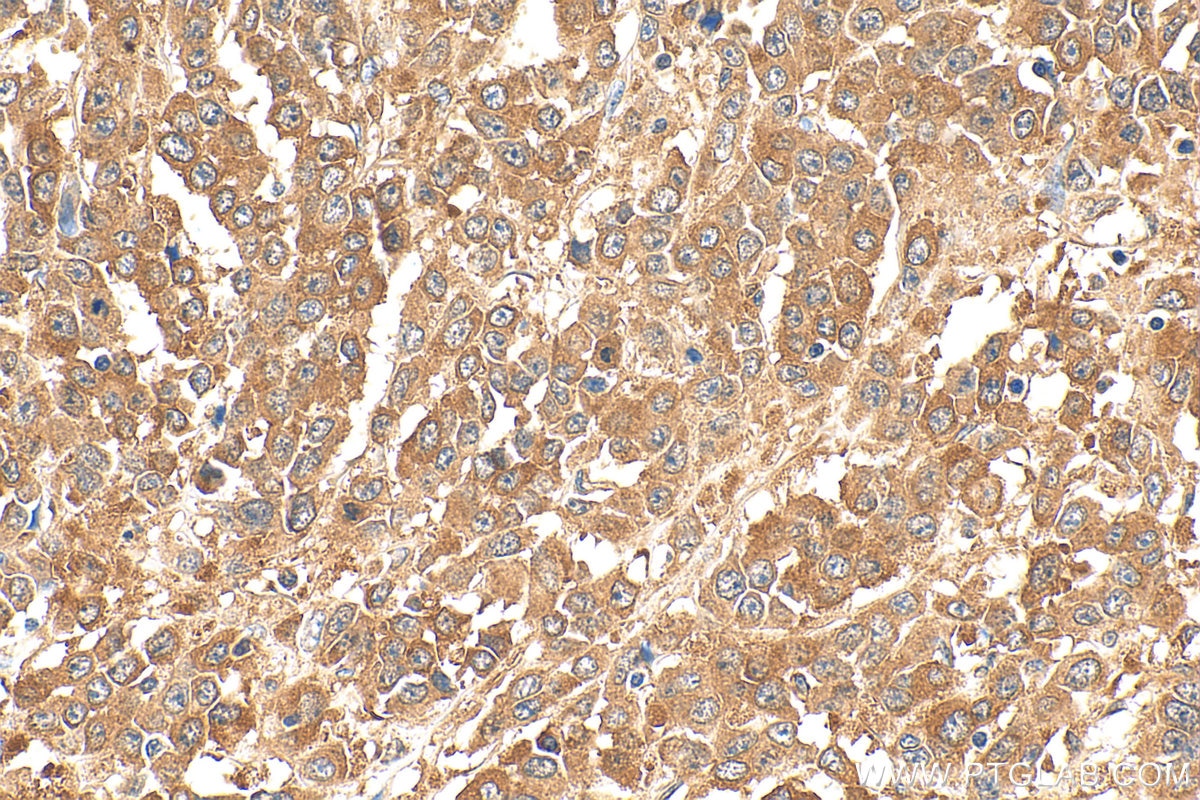 Immunohistochemistry (IHC) staining of human colon cancer tissue using KRAS Polyclonal antibody (12063-1-AP)
