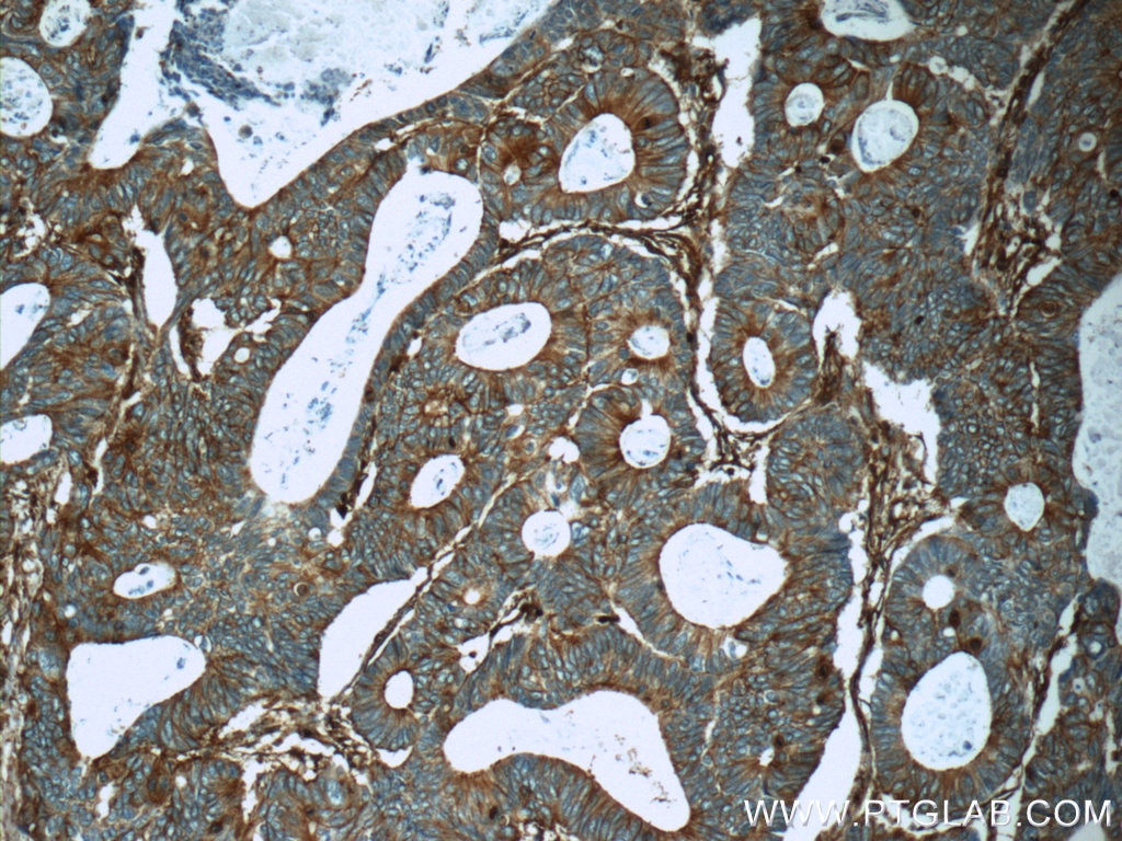 Immunohistochemistry (IHC) staining of human colon cancer tissue using pan Ras Monoclonal antibody (60309-1-Ig)