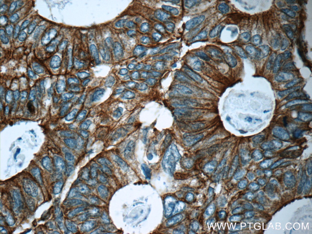 Immunohistochemistry (IHC) staining of human colon cancer tissue using pan Ras Monoclonal antibody (60309-1-Ig)