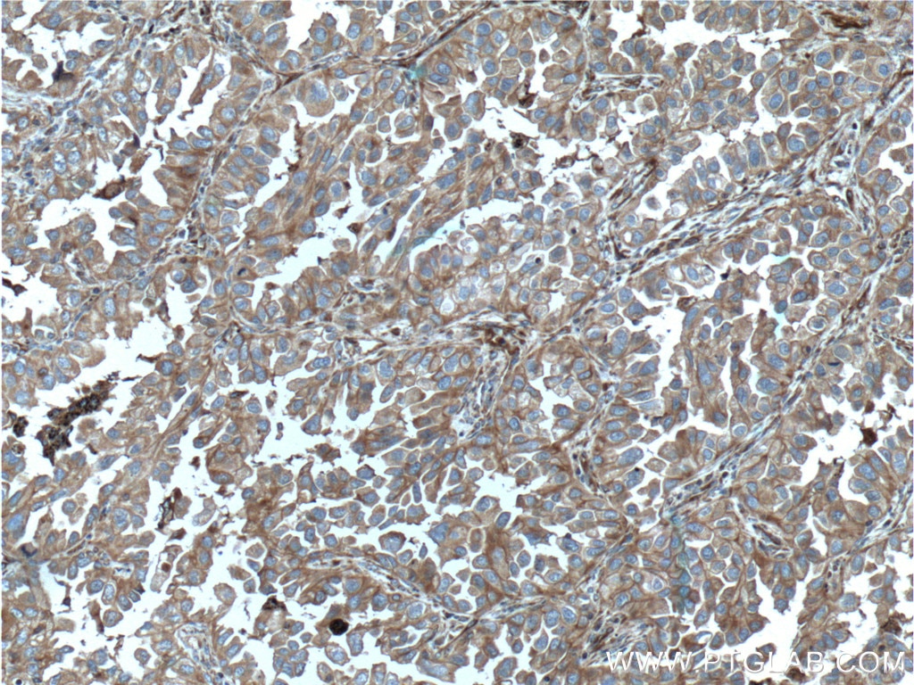 Immunohistochemistry (IHC) staining of human lung cancer tissue using pan Ras Monoclonal antibody (60309-1-Ig)