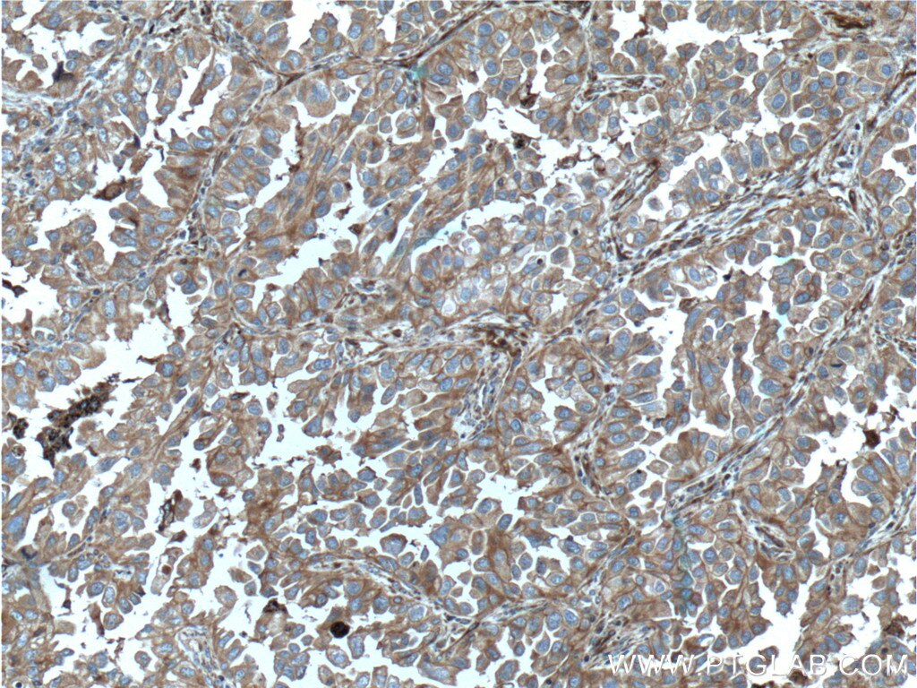 IHC staining of human lung cancer using 60309-1-Ig