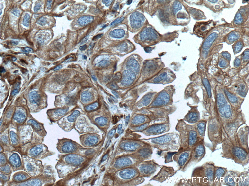 Immunohistochemistry (IHC) staining of human lung cancer tissue using pan Ras Monoclonal antibody (60309-1-Ig)