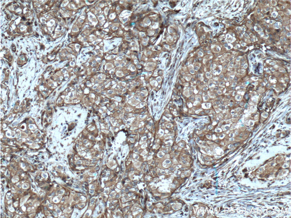 Immunohistochemistry (IHC) staining of human breast cancer tissue using pan Ras Monoclonal antibody (60309-1-Ig)