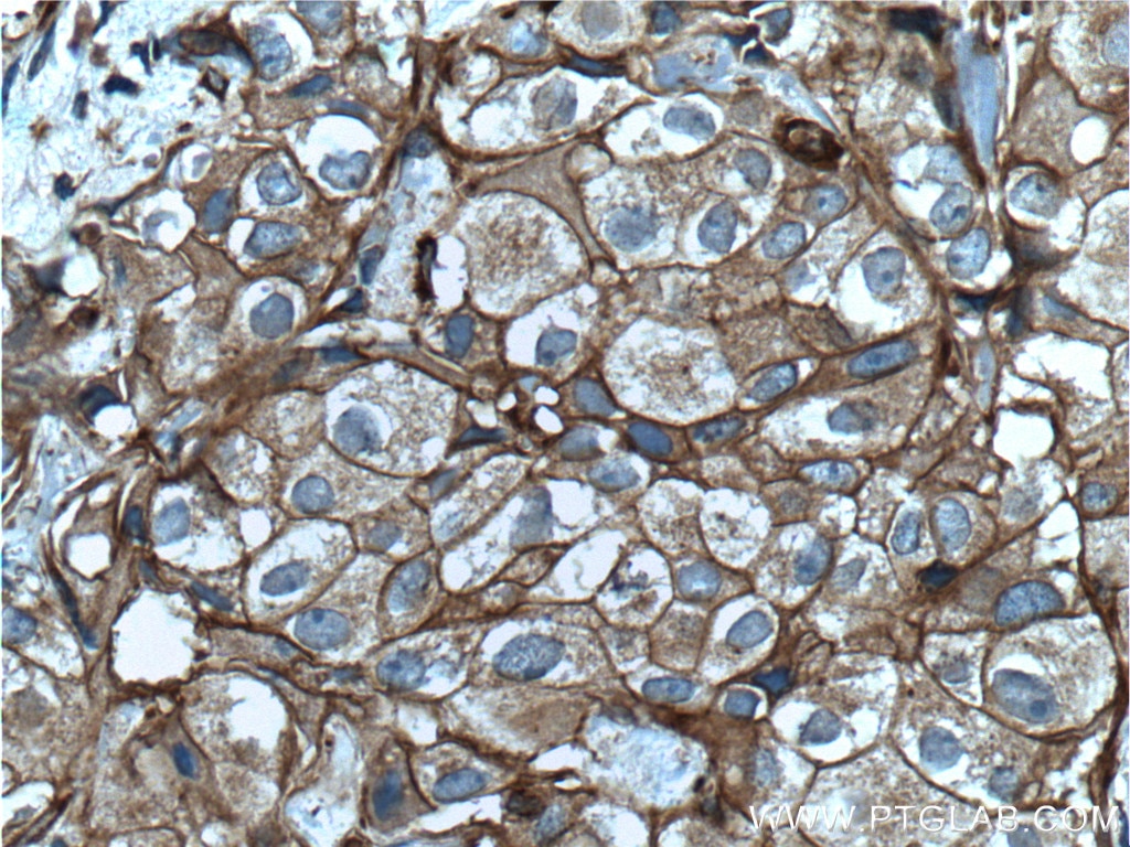 Immunohistochemistry (IHC) staining of human breast cancer tissue using pan Ras Monoclonal antibody (60309-1-Ig)